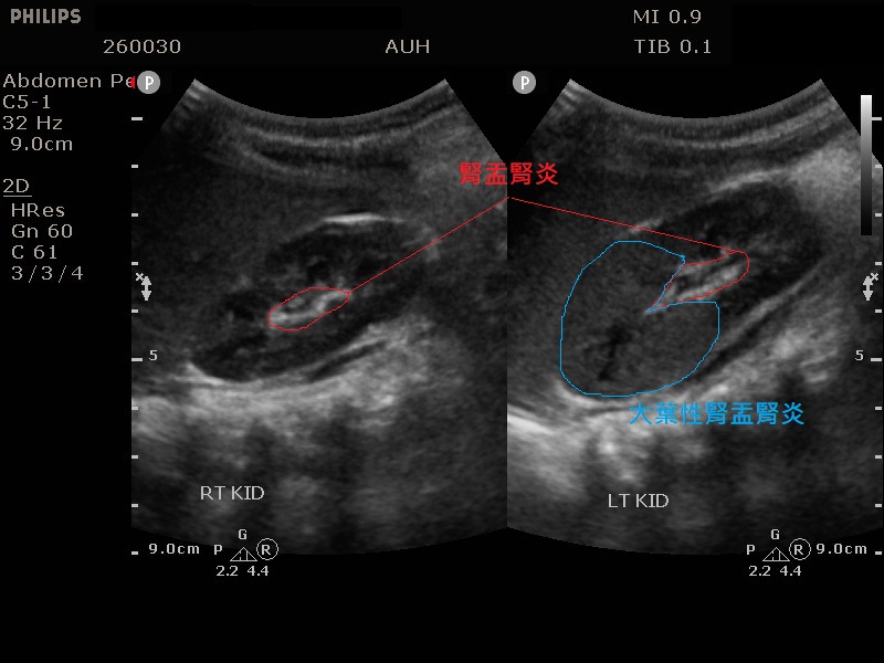 嬰兒高燒不停要注意 大葉性腎盂腎炎 恐害慢性腎衰竭 匯流新聞網