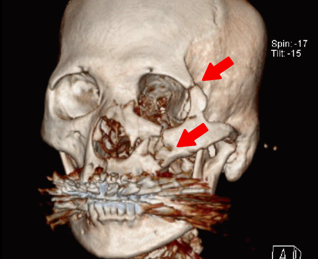 醫師都嚇到 低頭族慘跌跤她遭腳踏車架穿透 半臉粉碎 匯流新聞網