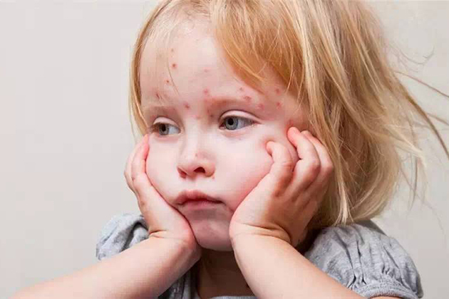 今年首例！1歲女童赴廣東染麻疹
