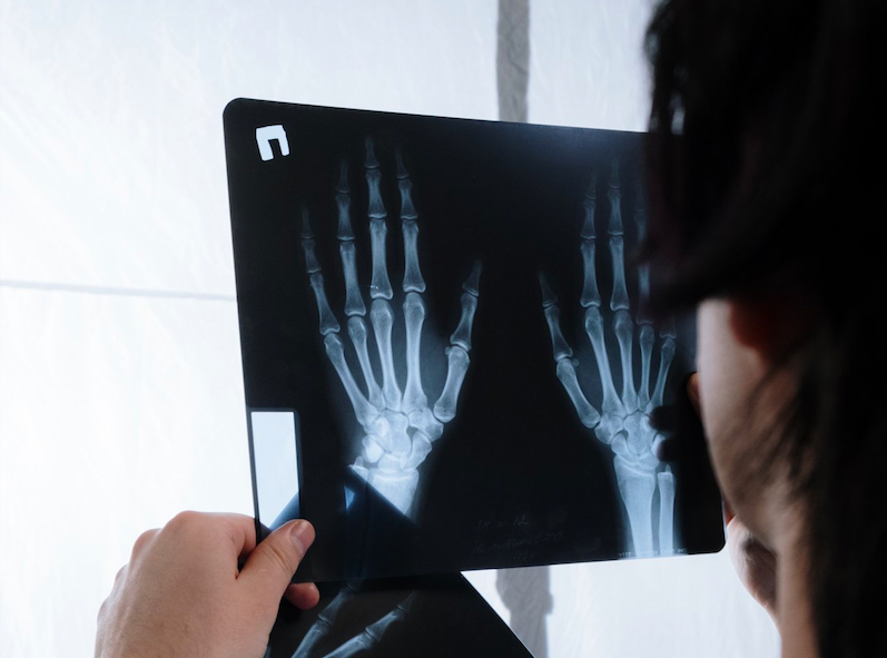 不只是皮膚病 罹患 乾癬 只看皮膚徵狀不夠恐爆35種疾病危機 匯流新聞網