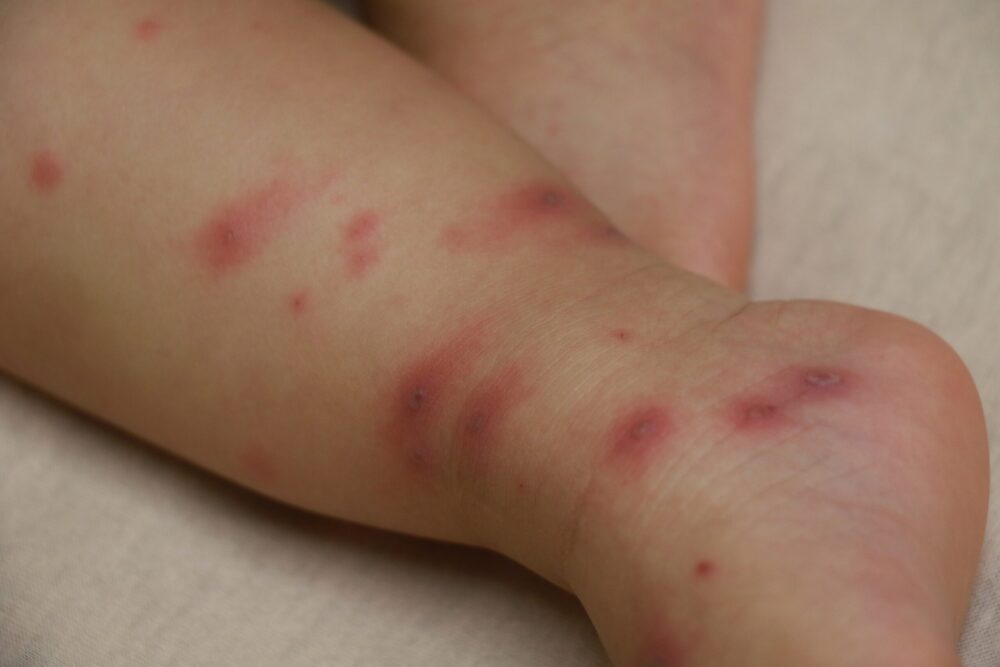只差幾天打疫苗…  小女嬰竟遭「皮蛇」爸傳染水痘、媽媽也中招