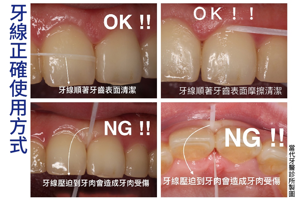 【有影】牙周病患怎麼正確刷牙、潔牙？ 牙線這樣用馬上就NG 5