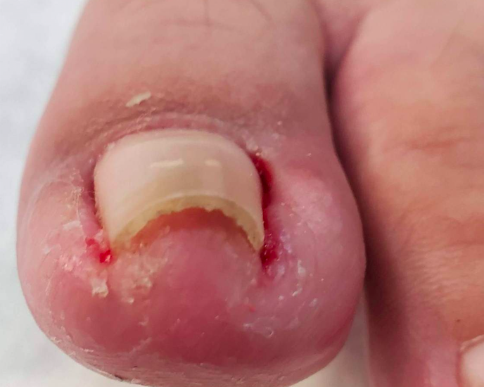 「凍甲」指甲越剪越小片  3症狀發作當心你離拔指甲只剩一步！