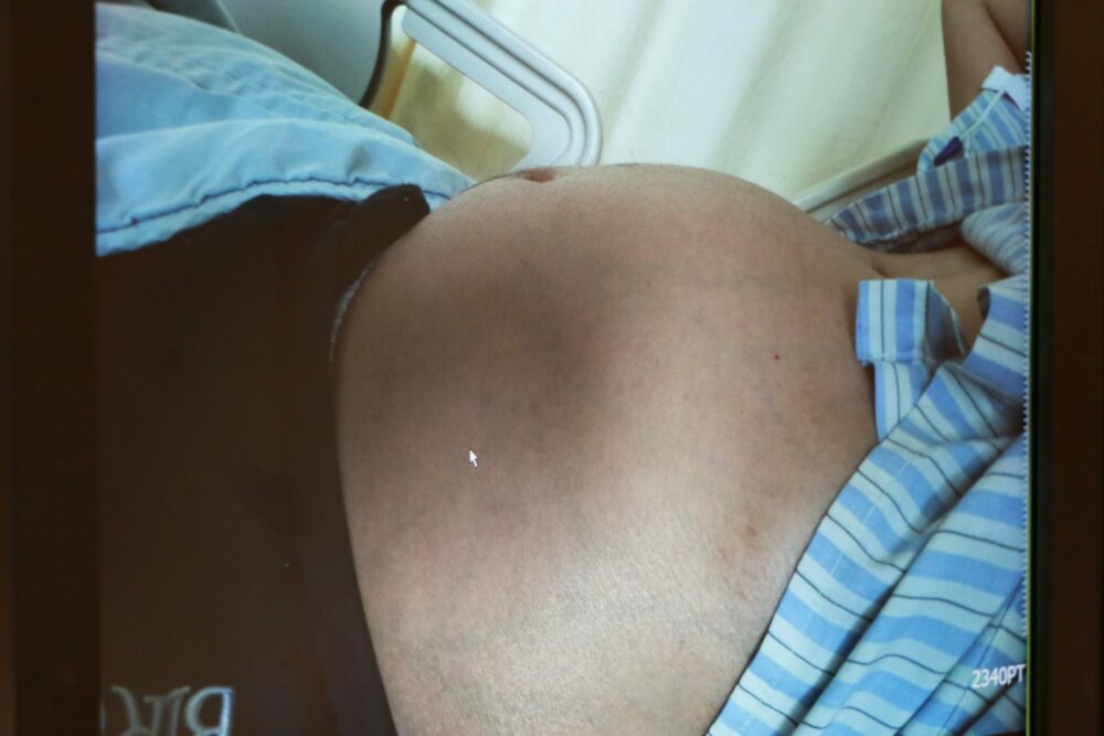 短短十多天「腹部隆起如懷胎」  男子肚藏4公斤巨瘤險喪命