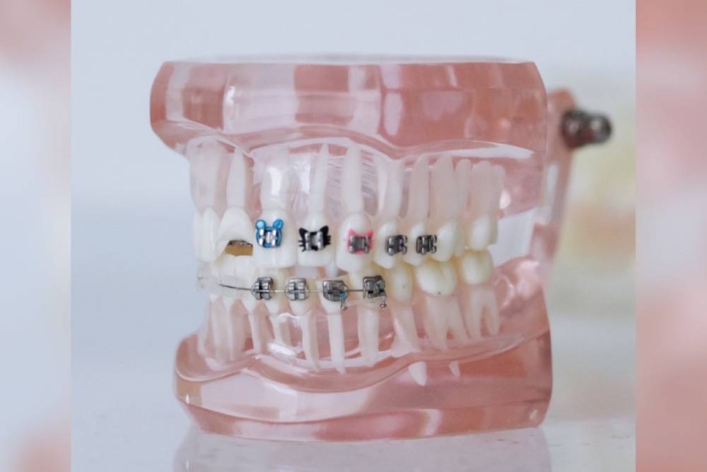 【有影】懵懵懂懂就付錢戴牙套？牙醫矯正流程大公開
