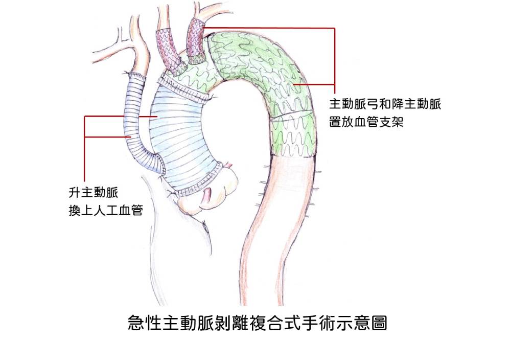 胖到-主動脈剝離-工程師-減重救命變型男