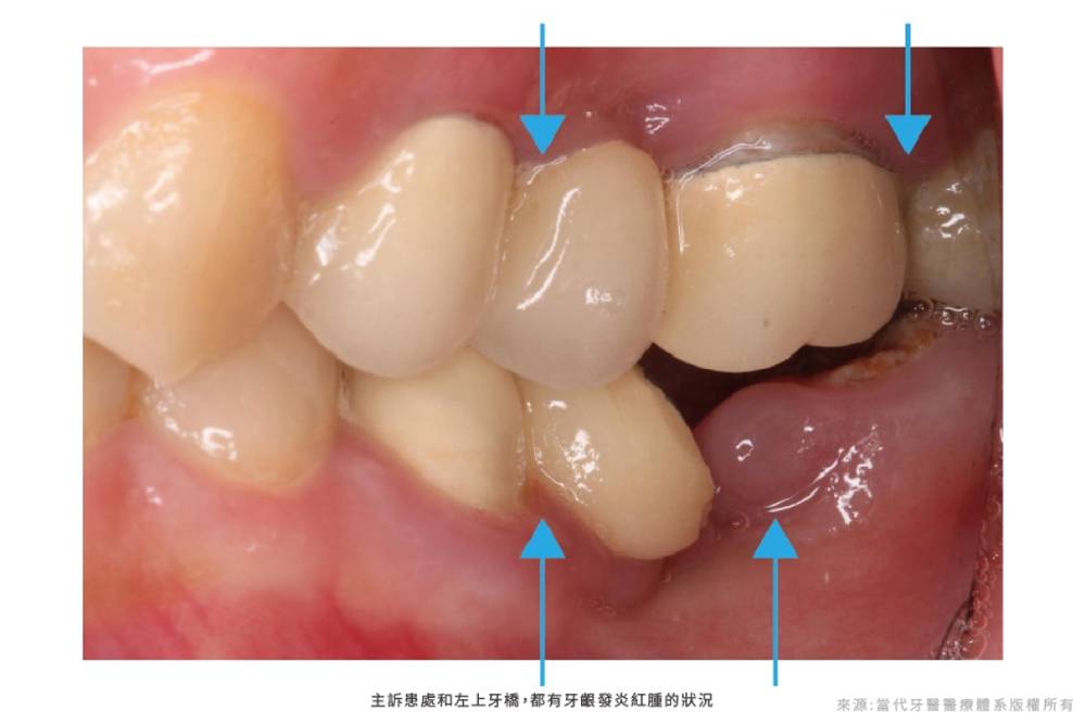強化口腔衛教避免牙周病增加植牙成功率