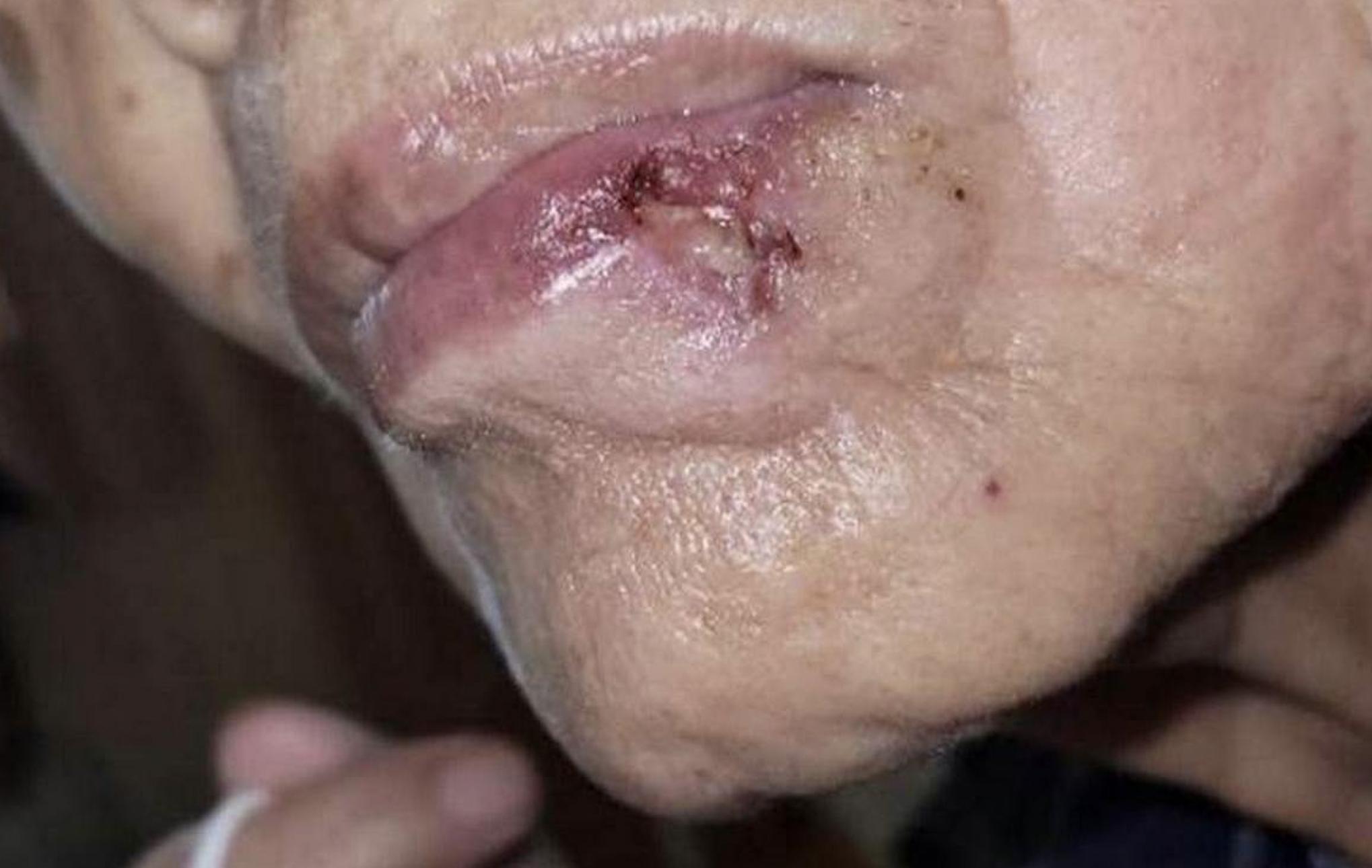 下唇突然長「痣」轉潰瘍   她短短數月由不痛不癢變皮膚癌