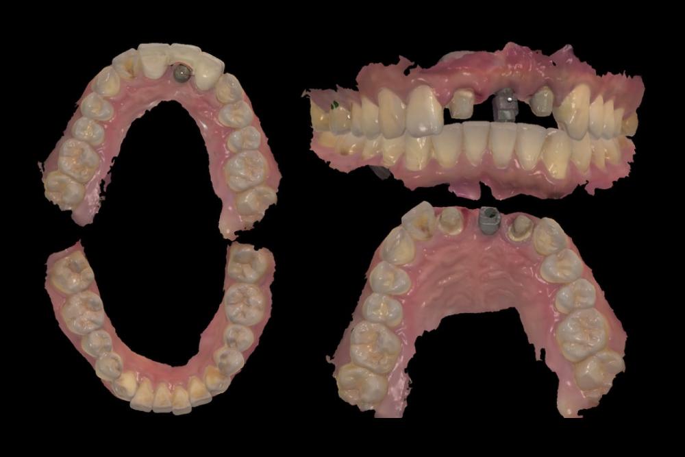 【有影】植牙補骨、人工植牙、全瓷冠搭配 有系統治好嚴重慢性牙周病