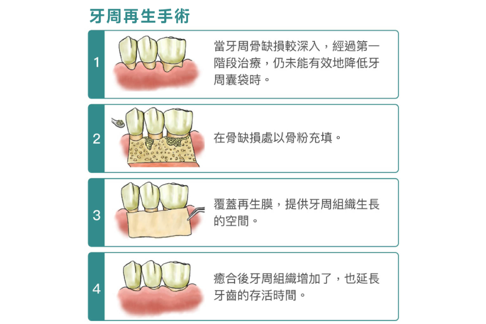 【有影】想兼顧牙齒治療、功能與美觀  嚴重牙周病完成兩階段治療有必要