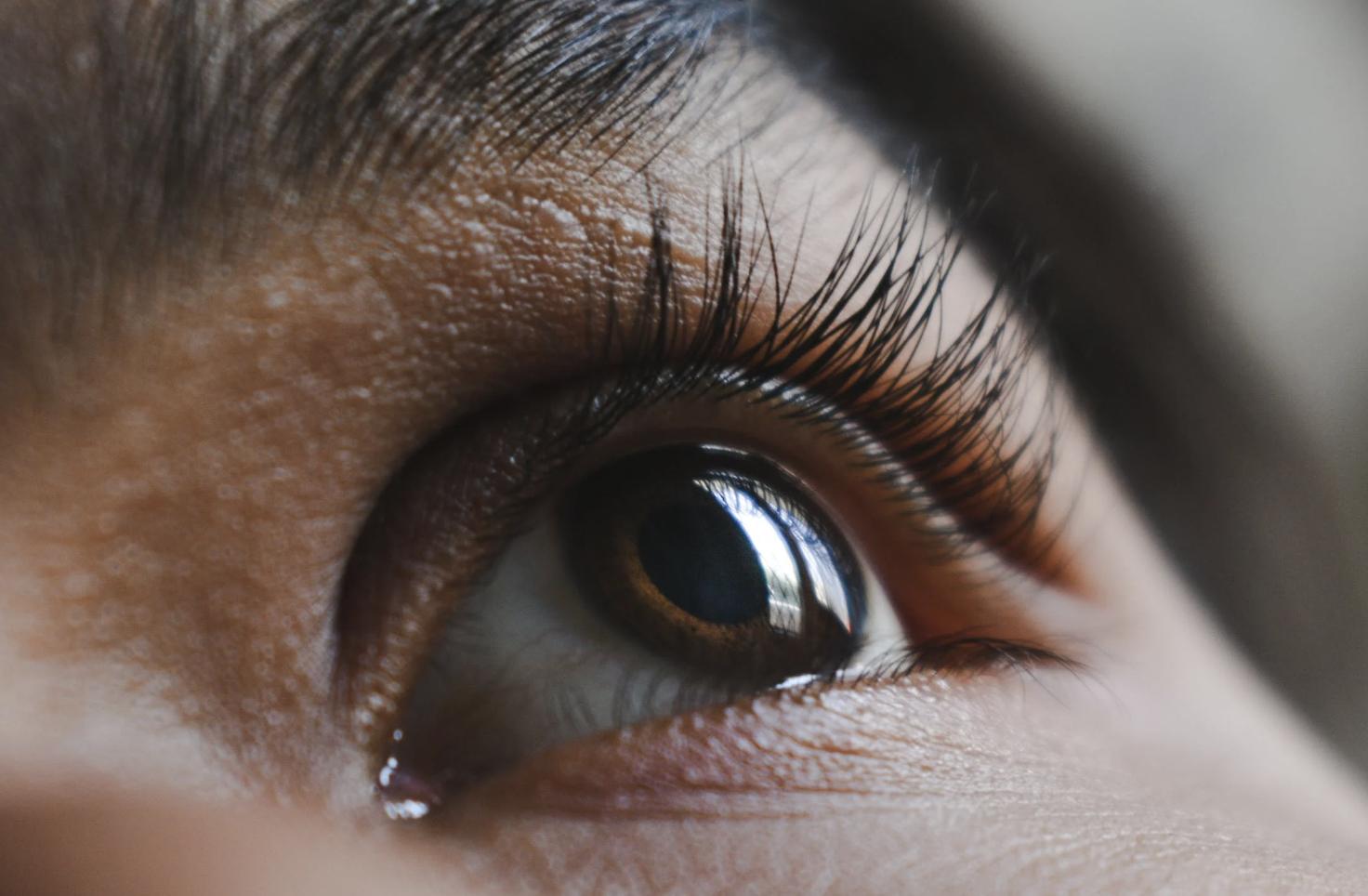 眼皮浮腫2個月不退   非單純過敏！甲狀腺眼病變三大徵兆一定要懂