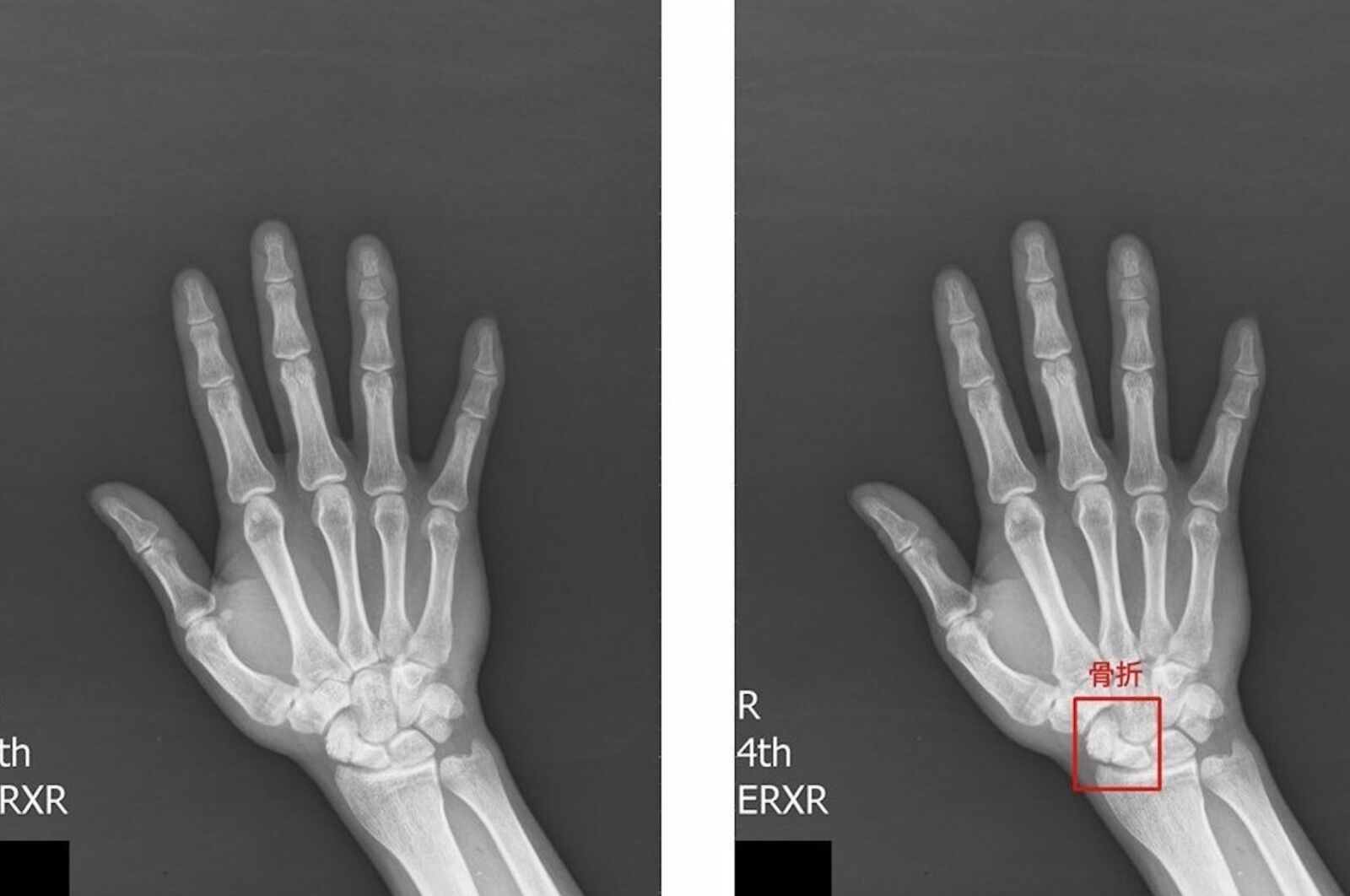 手腕長期疼痛≠肌肉損傷 這種骨折太常被忽略！林口長庚成功發展偵測AI 5