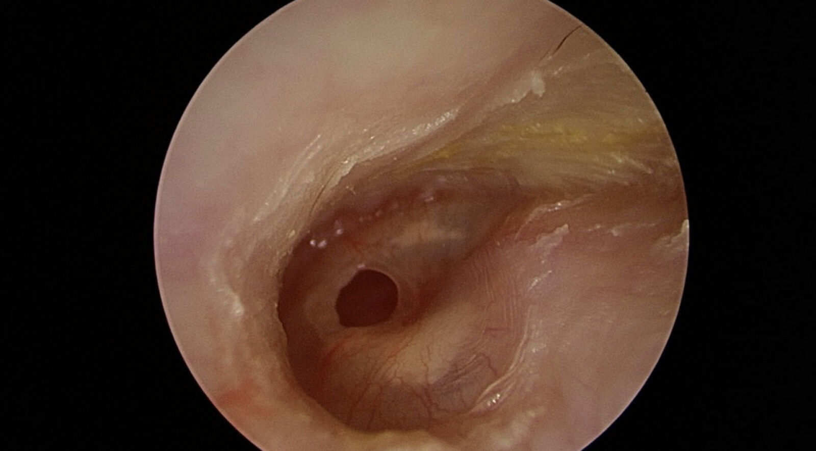 婦人接連感冒竟「聽不清、耳流湯」 醫師一看耳膜破大洞了 251