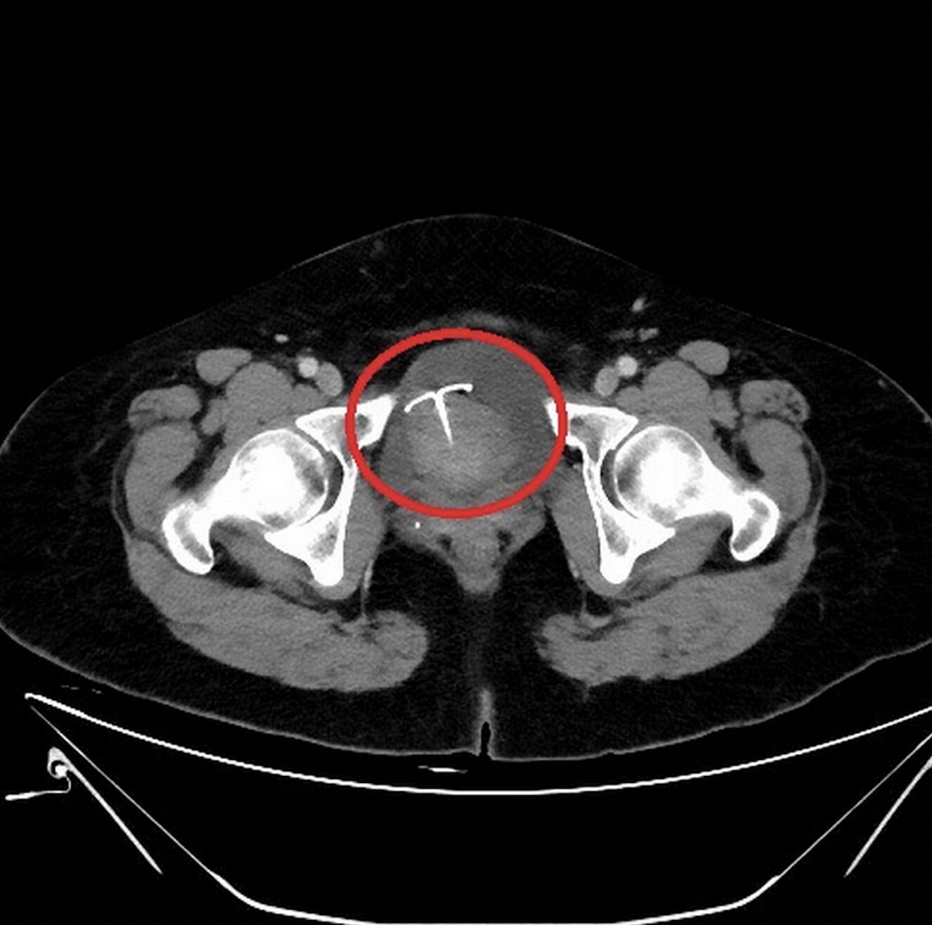 腹痛1個多月不停！ 她裝了就忘「避孕器穿透子宮」急摘子宮 11