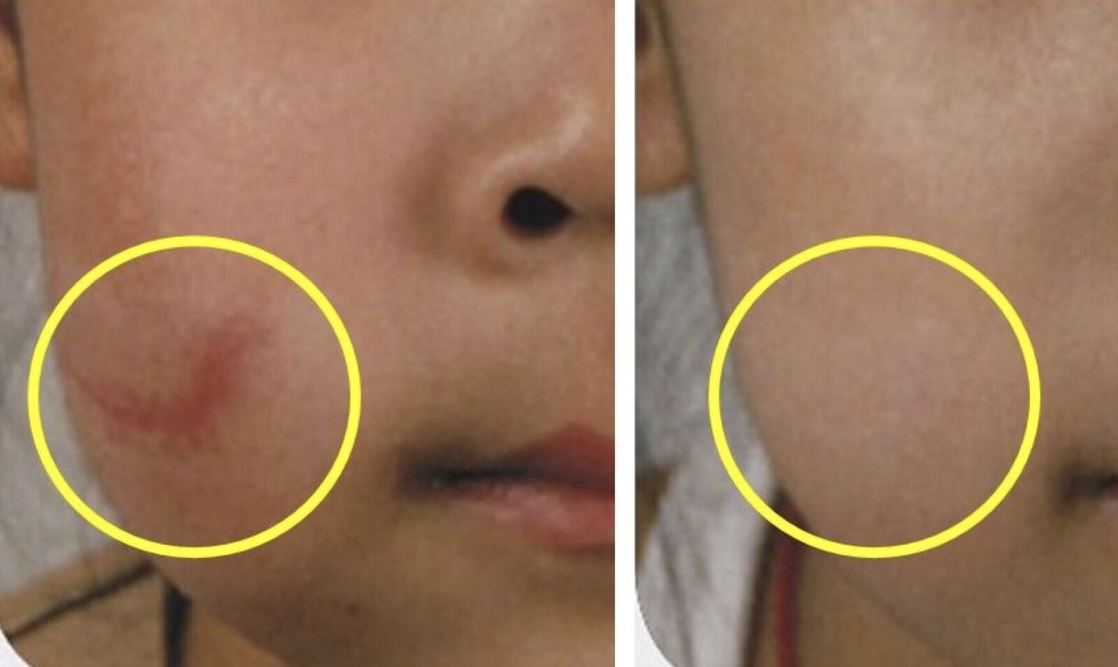 女童摔一跤臉冒「7公分紅疤」   醫出招甩掉疤痕增生！必知傷口護理秘訣