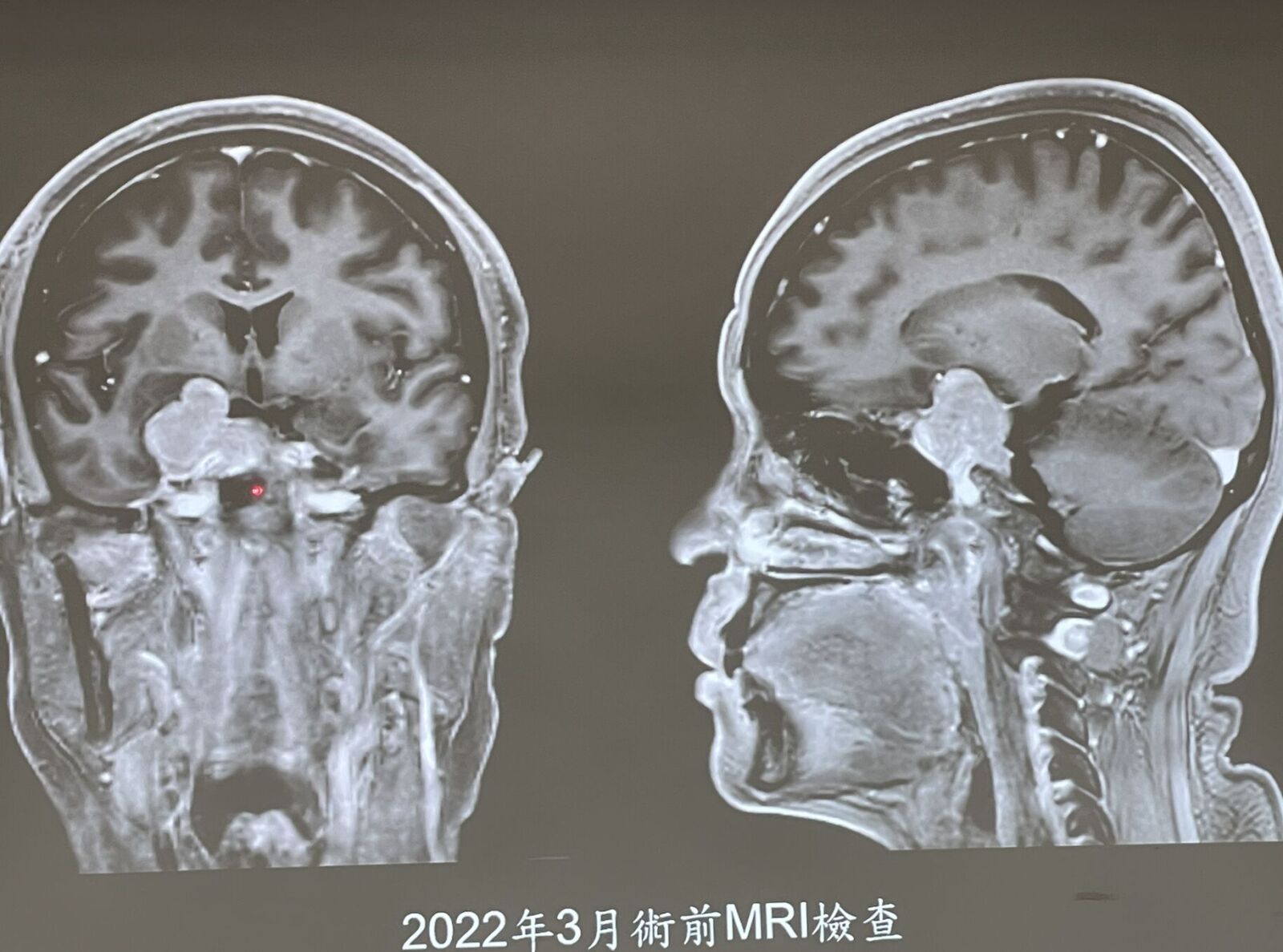 嚇壞！騎車一半「眼前事物全歪斜」 原來4公分腫瘤壓眼險失明 215