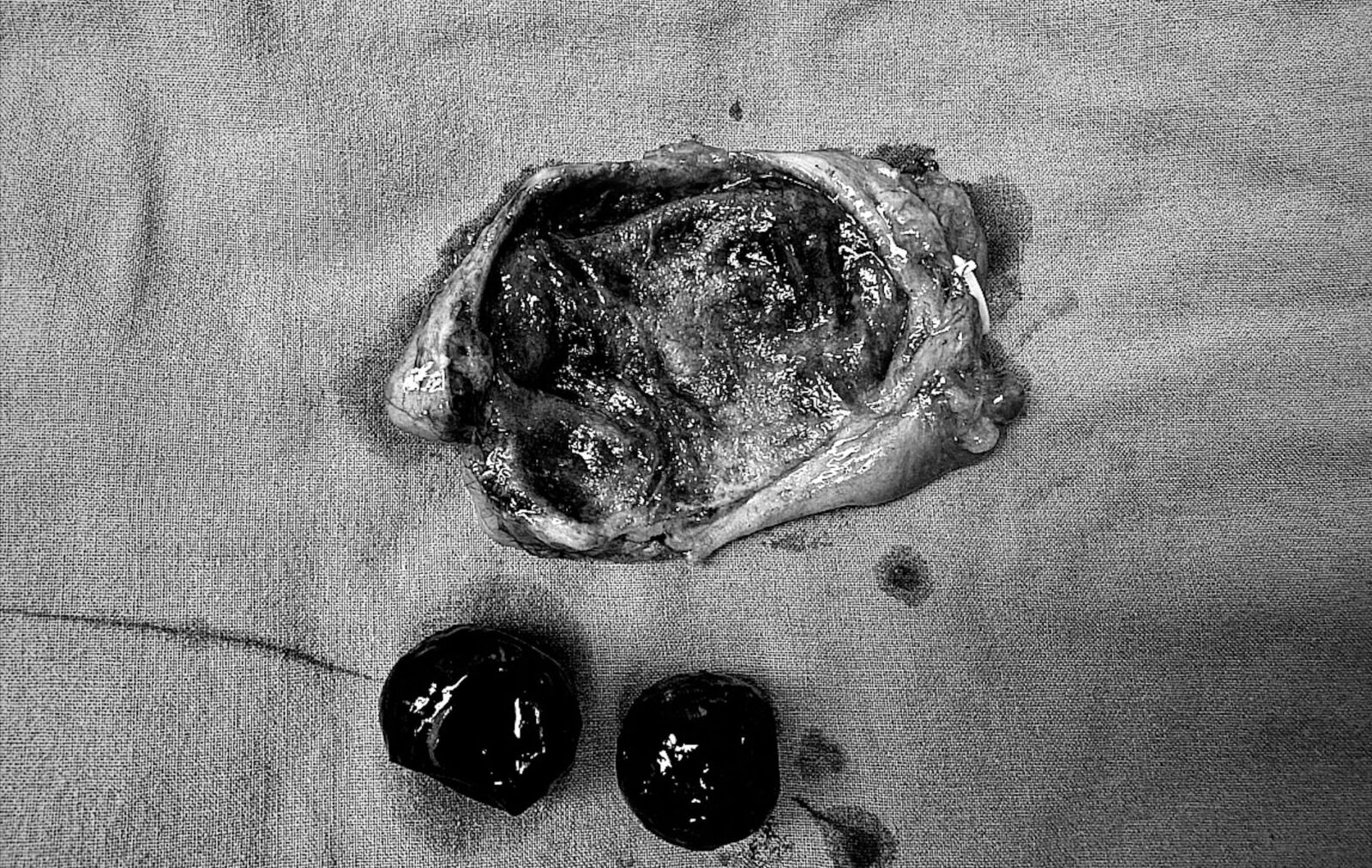 她大嗑火鍋後狂痛 切開膽囊驚見兩顆「黑色大粉圓」作怪 7