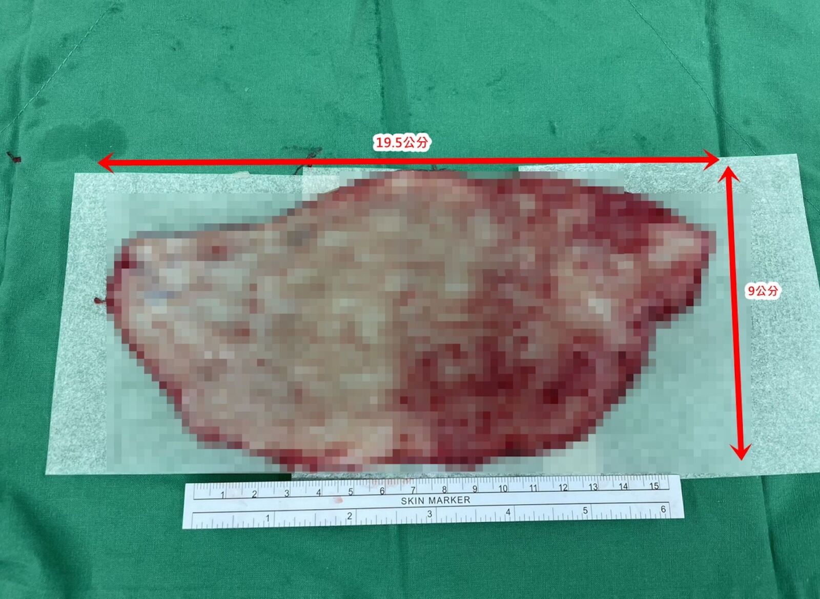 她慘遭機車「掀開整片大腿皮」血肉淋漓！ 醫師巧手種回全層皮膚 9