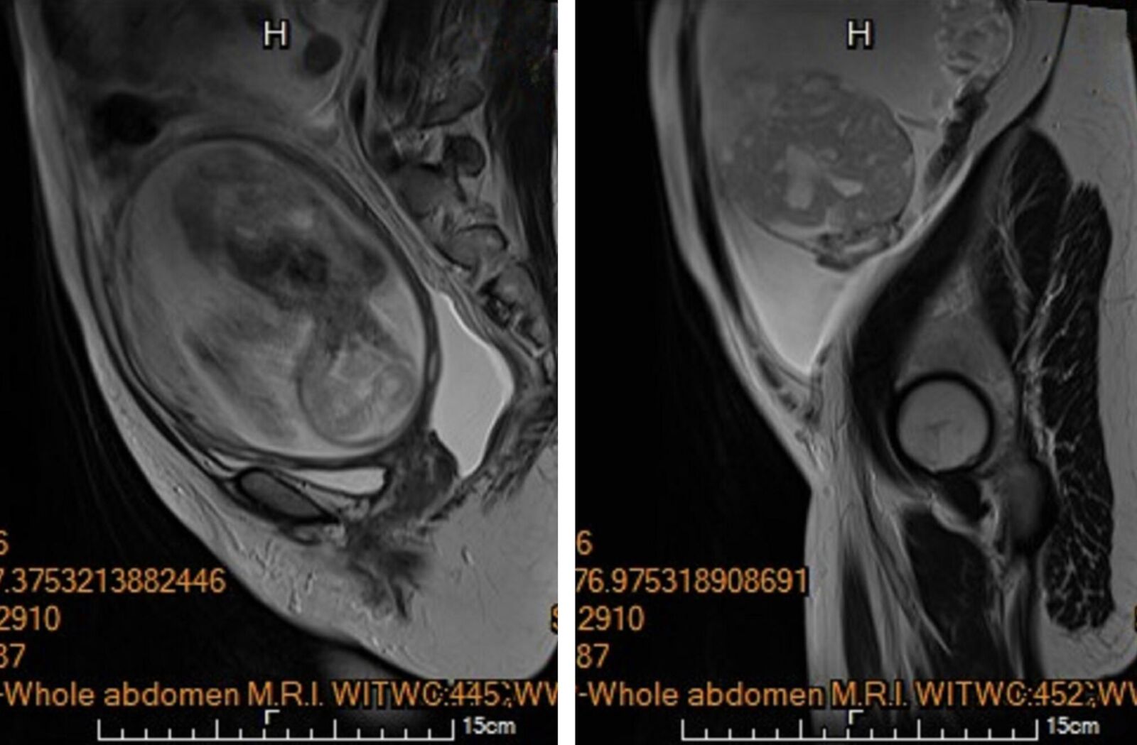 懷孕5月驚見「孩子身旁長出大腫瘤」！ 馬偕醫巧手拆彈保住胎兒 3