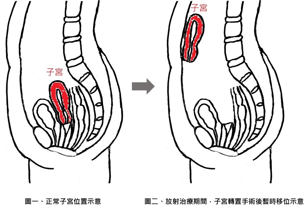 全台首例子宮轉置手術! 她23歲直腸癌「暫移子宮」保住生育力 20 全台首例子宮轉置手術! 她23歲直腸癌「暫移子宮」保住生育力 19