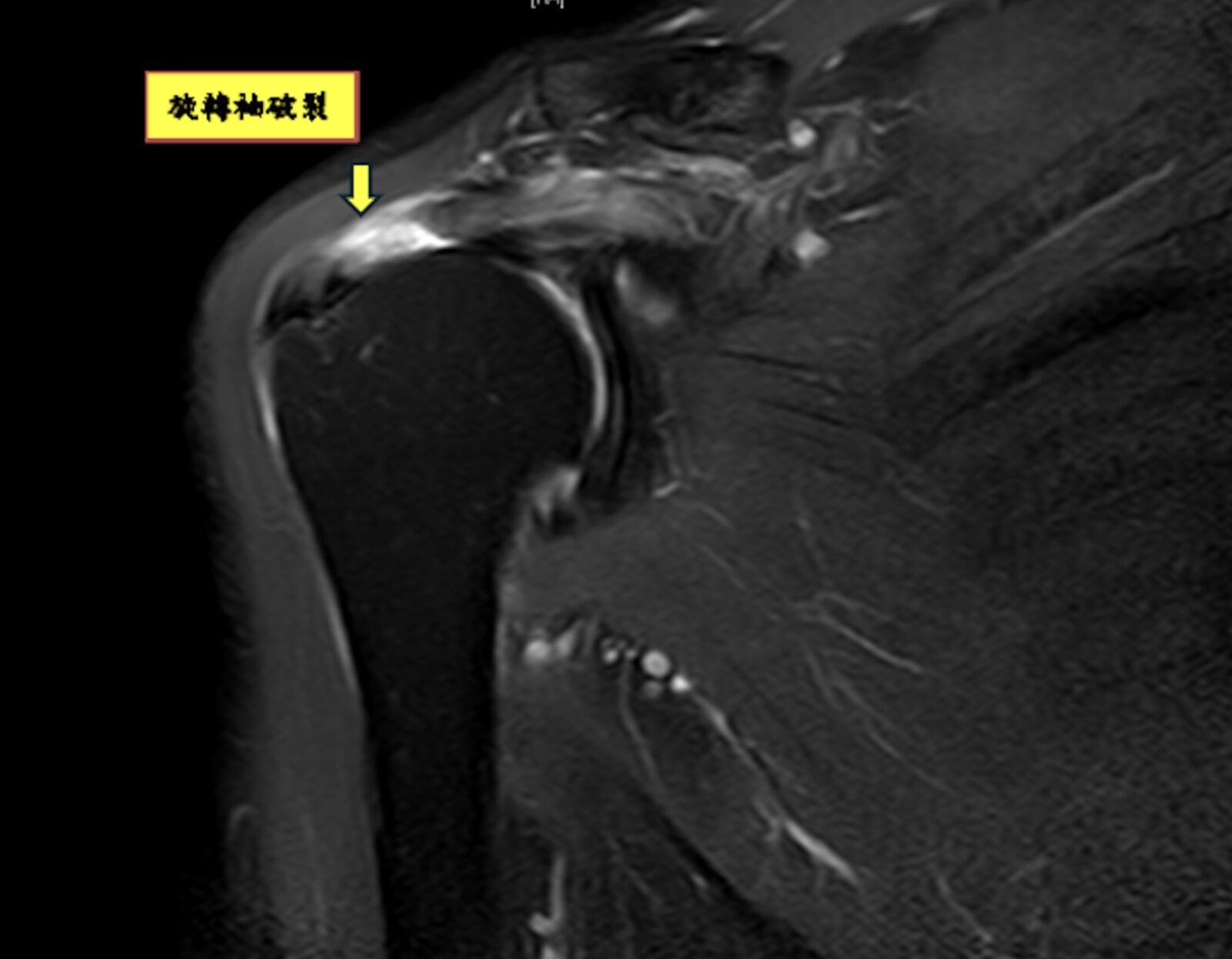 肩膀抬不起來只是五十肩? 復健再多都無用!旋轉袖破裂恐開刀 19 肩膀抬不起來只是五十肩? 復健再多都無用!旋轉袖破裂恐開刀 18