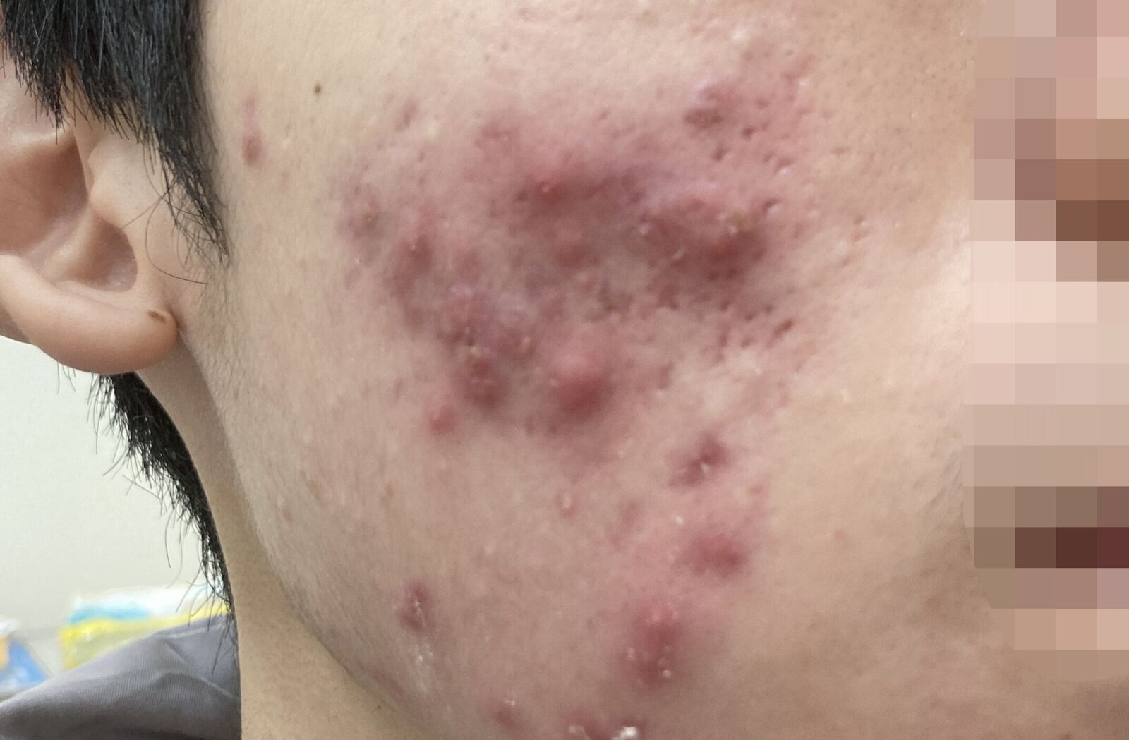 春春痘也分類「這一種」發紅劇痛！ 醫曝黃金治療期少留疤 3