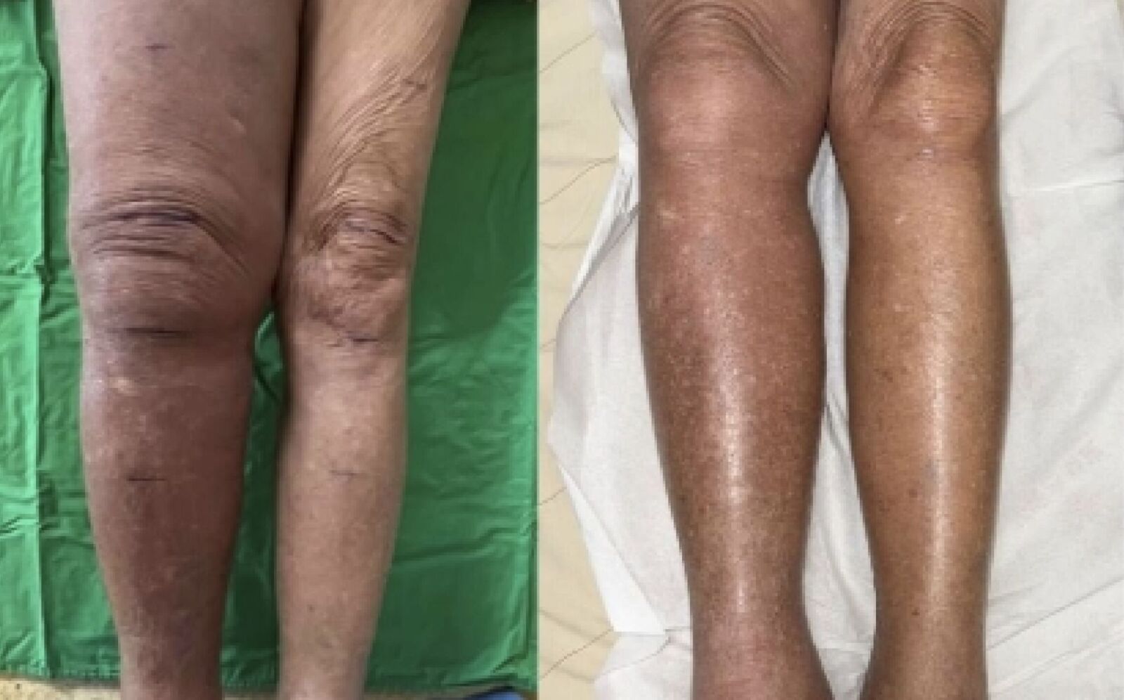 她「一腳水腫3倍大」險長期臥床 醫神手用比髮細縫線吻合血管拆彈 3