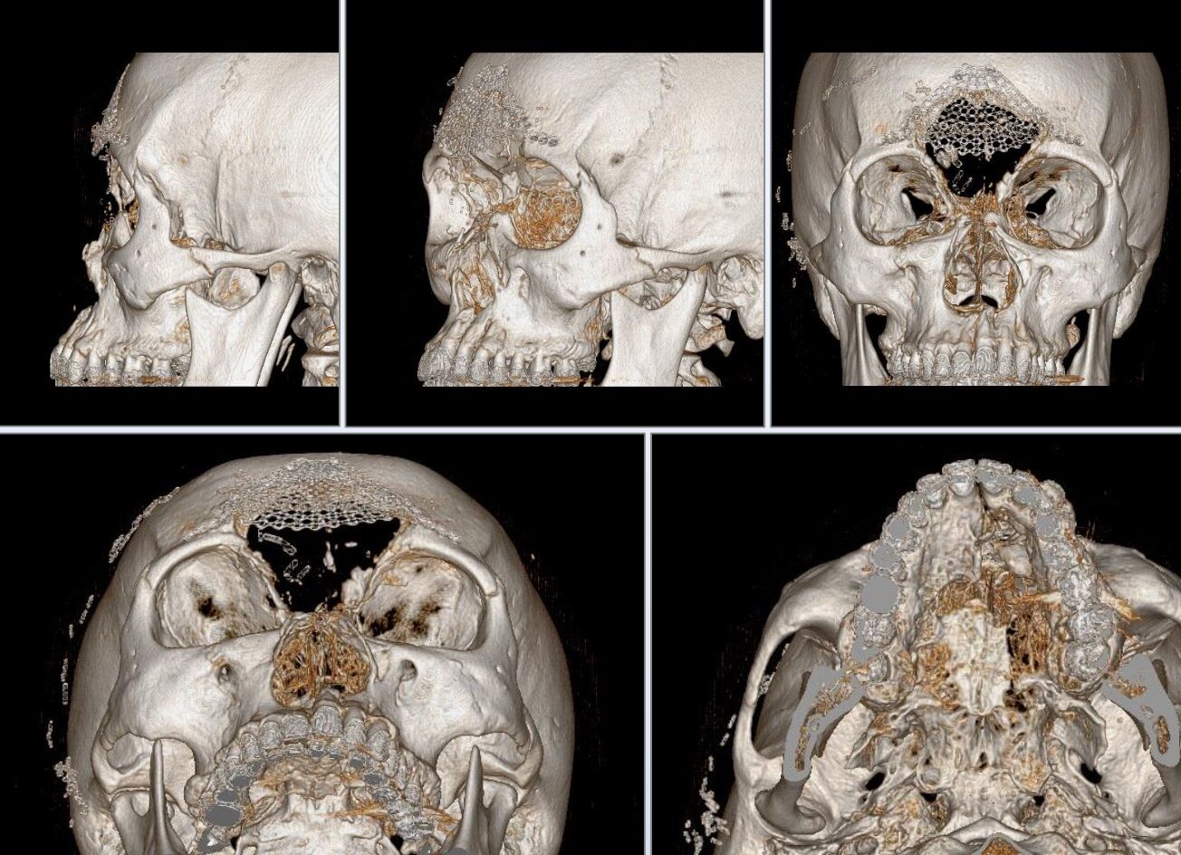 男遭T91步槍轟穿臉骨粉碎！ 三總醫巧手+3D列印「拚回整張臉」 3
