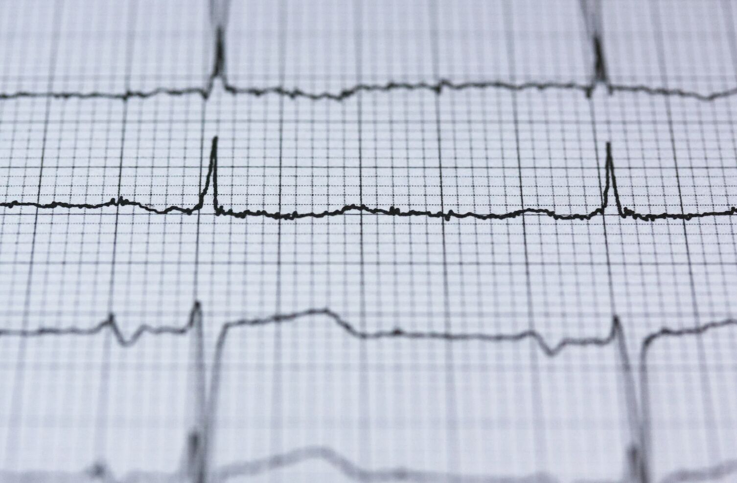 吃飽「一陣冷風吹來」頭暈、噁心 她竟心房顫動短暫性中風! 吃飽「一陣冷風吹來」頭暈、噁心 她竟心房顫動短暫性中風!