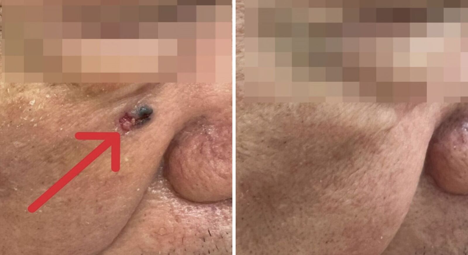 男臉上冒黑斑「不痛不癢」 再一看長大了！竟是皮膚基底細胞癌 15