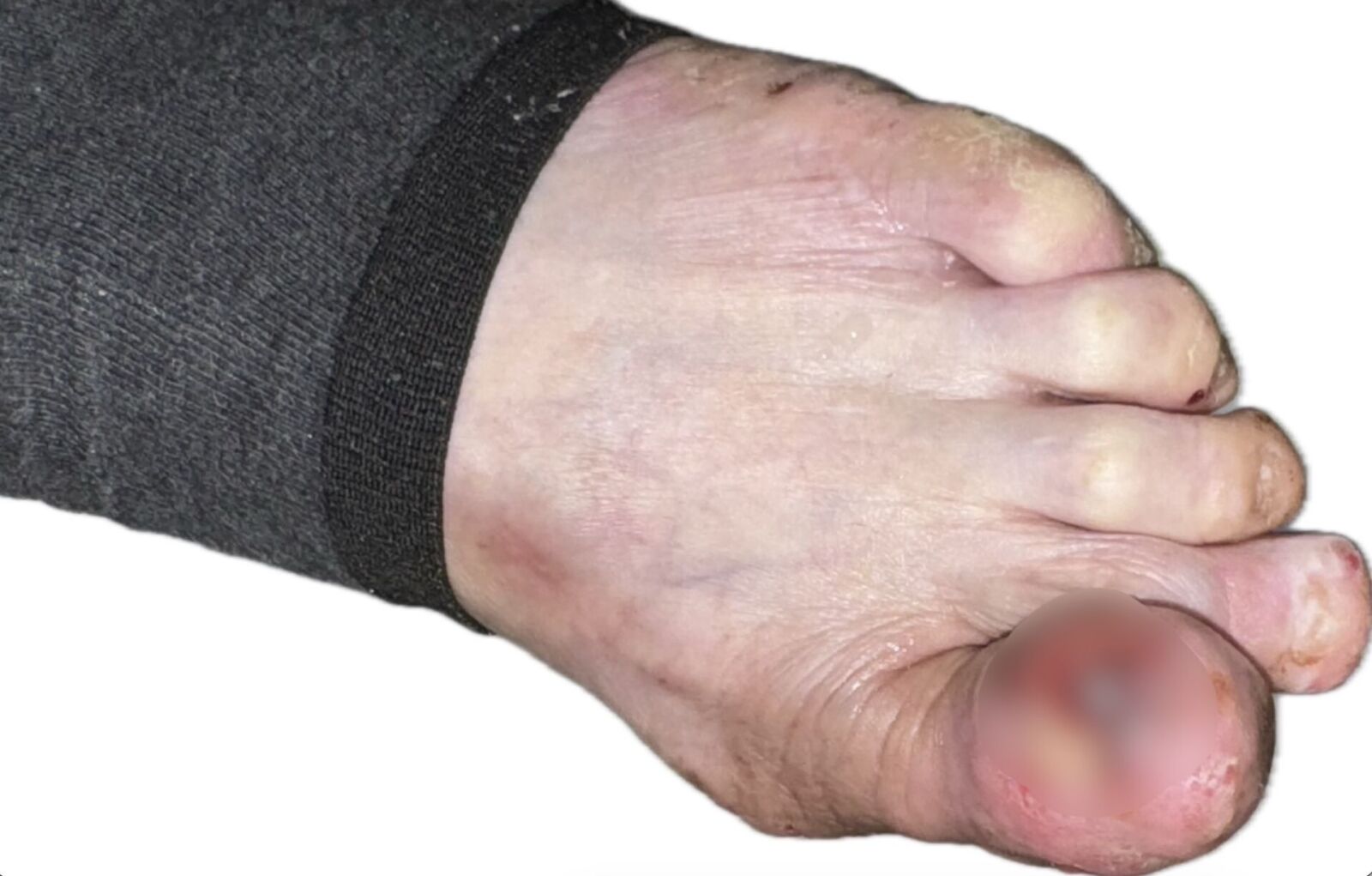 腳趾紅腫、化膿一年多難穿鞋   婦人「惡癌」錯當甲溝炎險丟命！