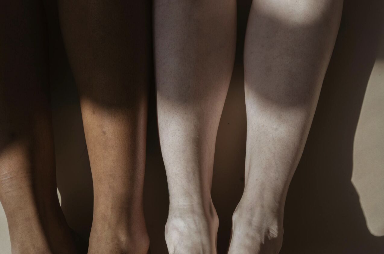 她一年來「鞋子買大兩號」  腎臟出問題？其實淋巴水腫作怪