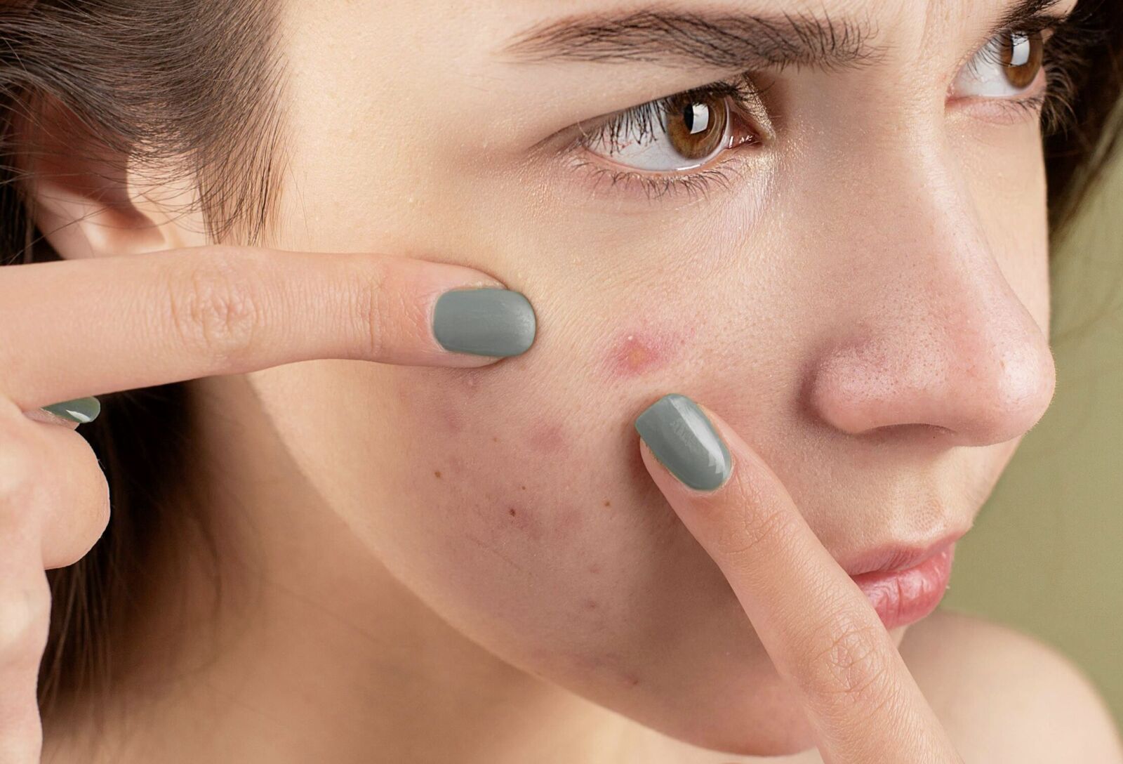 顛覆印象！30至49歲冒「青春痘」最慘 元凶並非臉洗不乾淨 7