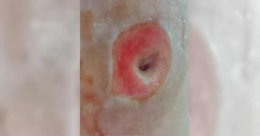 40歲女強人長硬塊！以為痘痘隨手亂塗藥　2個月後「臉被掏空1個洞」