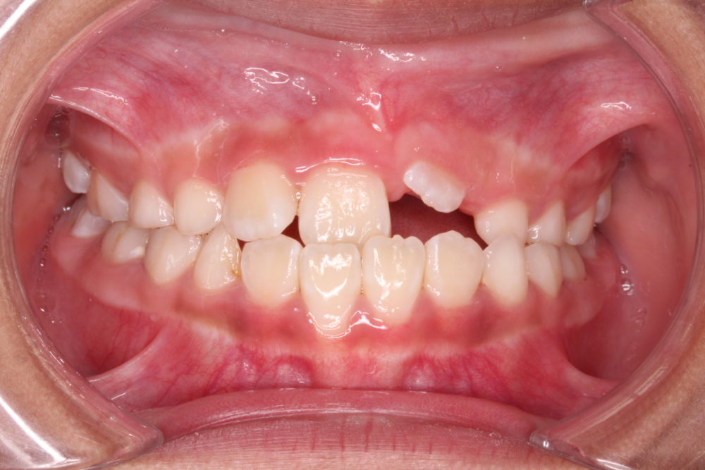 大笑驚見缺2顆牙  9歲童門牙深埋牙齦花2年才拉出