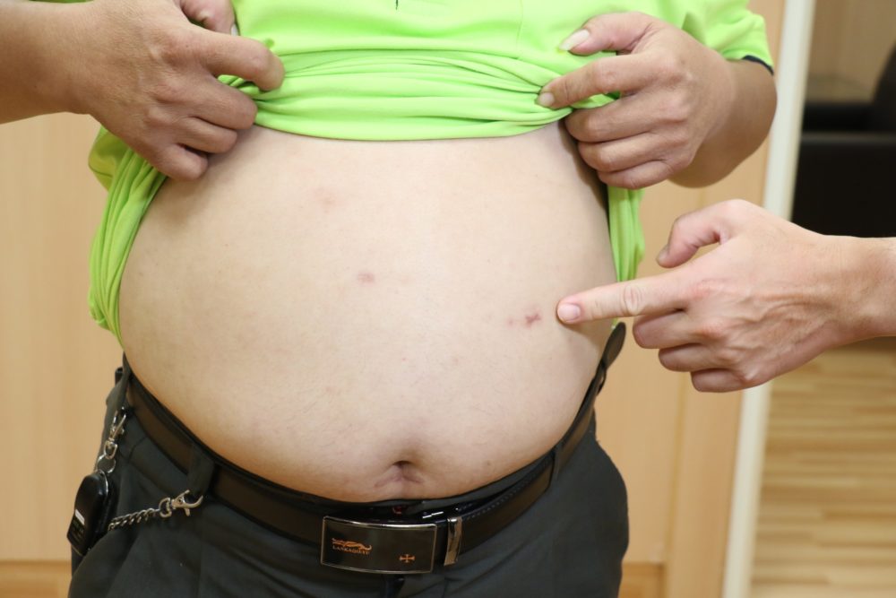 餐廳主廚體重吃破百公斤  「縮胃」只留1/3胃容量急救健康