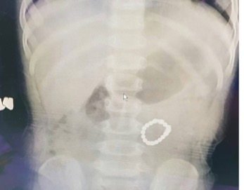 誤吞18顆磁力球「腸內聚成圈」  1歲童肚痛切腸
