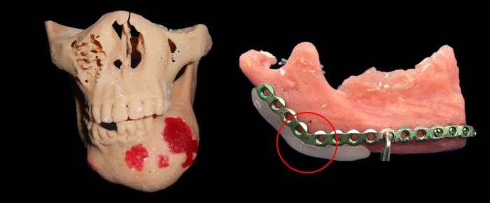 左：3D列印重建病患下顎骨模型；右：於模型上預先客製化骨板及製作導引板