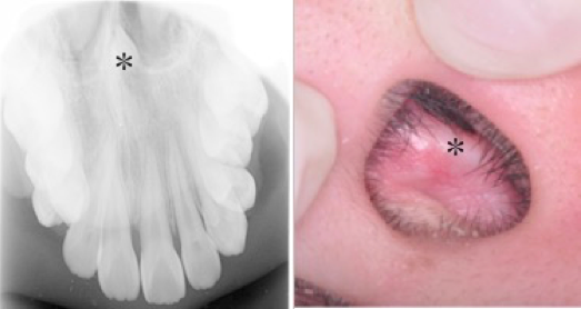 嘴裡「多生牙」長到鼻腔  北榮研究：兒童贅生齒早期拔除莫輕忽