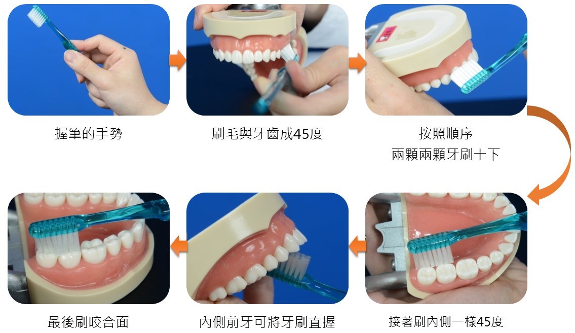 牙周病拖延治療 40多歲的她沒剩幾顆牙「三餐得打碎吃」 5